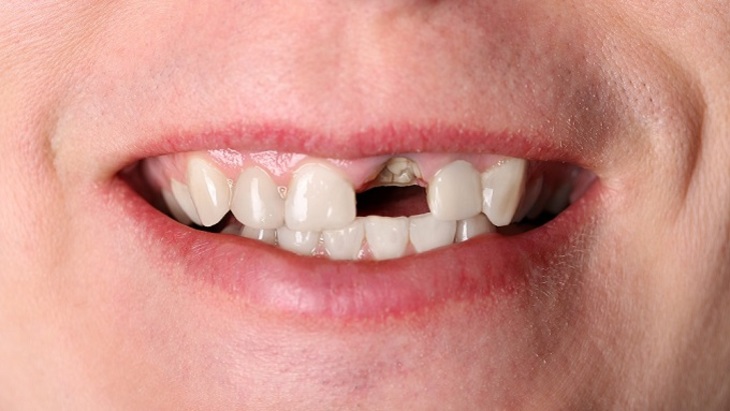 Вершки и корешки: можно ли спасти зуб, от которого остался только корень? - фото