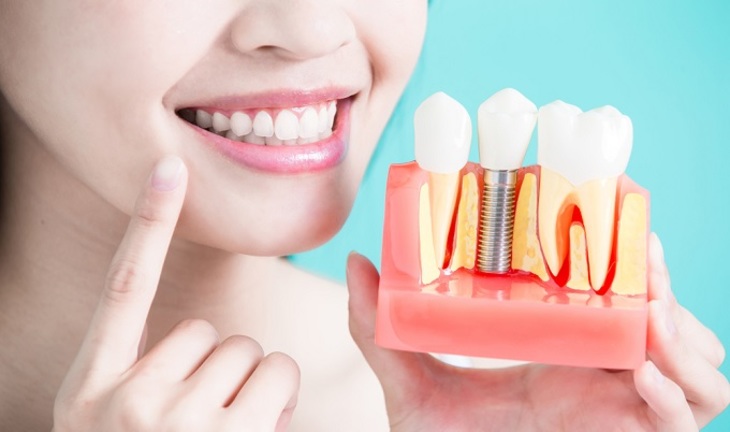 7 причин не откладывать имплантацию зубов - фото