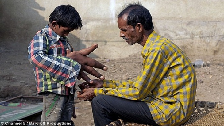 В Индии живет мальчик с руками гигантских размеров - фото