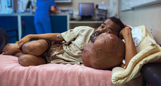 Шок: жителю Мадагаскара удалили 7-килограммовую опухоль