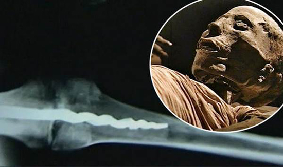 В древней мумии нашли современный ортопедический штифт